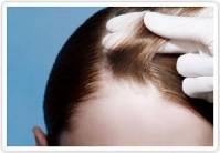 L'alopecia occipitale del neonato non è dovuta alla frizione